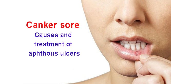 You are currently viewing What is a canker sore? Causes, symptoms and treatment of aphthous ulcers