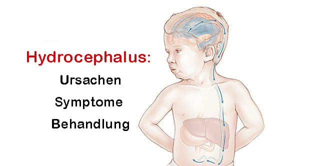 Gehirnblutung anzeichen