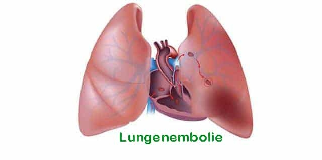 was-ist-eine-lungenembolie-symptome-ursachen-und-behandlung