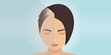 ¿Cómo prevenir la caída del cabello? Causas, prevención y tratamiento