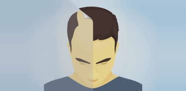 Read more about the article FUT hair transplant: Procedure, benefits, risks and suggestions