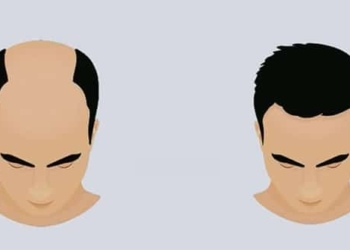 Hair loss: Causes, prevention methods and treatment