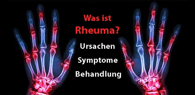 Rheuma Online Erfahrungsportal – YEUAQO