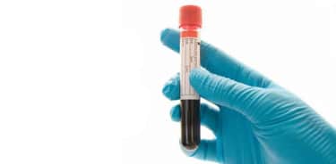 Read more about the article What is CRP test? Why does C-Reactive Protein level rise in blood?