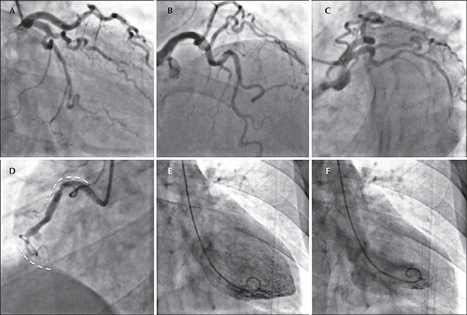 Angiography Angiogram Preparation Procedure Results And Risks