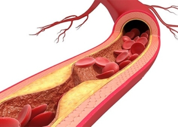 What is atherosclerosis? Causes, symptoms and treatments