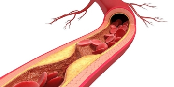 What is atherosclerosis? Causes, symptoms and treatments