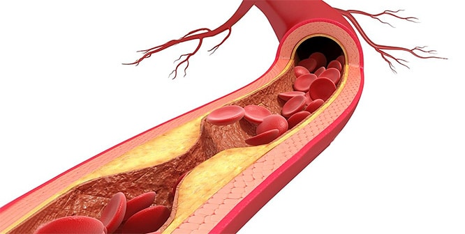 You are currently viewing What is atherosclerosis? Causes, symptoms and treatments