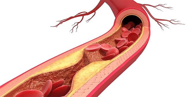 Подробнее о статье Что такое атеросклероз? Причины, симптомы и лечение