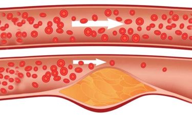 Causes of atherosclerosis