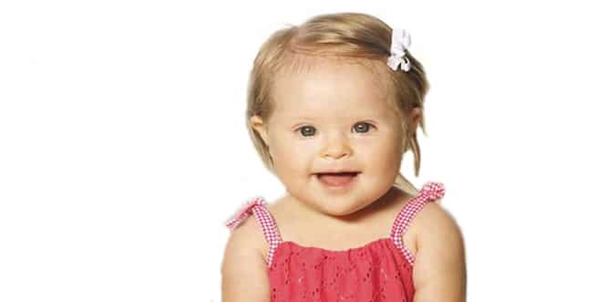 You are currently viewing What is Down Syndrome? Causes, symptoms, diagnosis and treatments