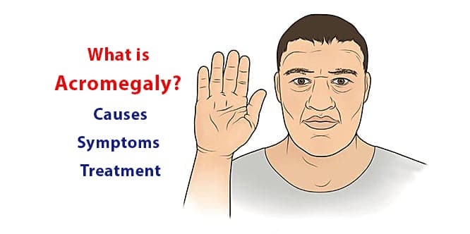 You are currently viewing What is acromegaly? Causes, symptoms and treatment