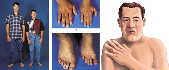 Acromegaly Pictures Before And After