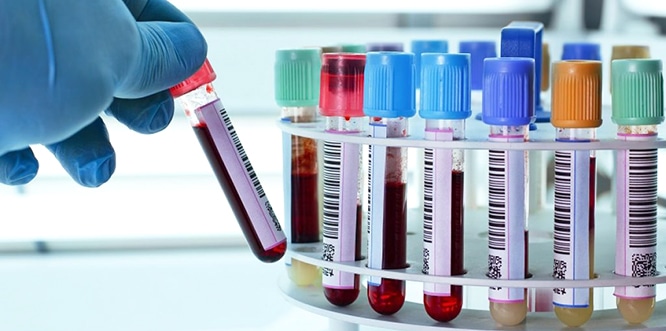Read more about the article Innovative Blood Test Can Easily Detect Parkinson’s in Its Very Initial Stages