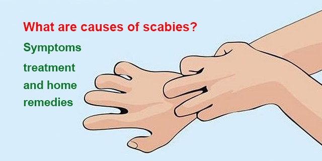 Scabies Rash Between Fingers