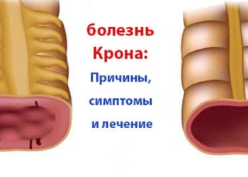 Что такое болезнь Крона? Причины, симптомы и лечение