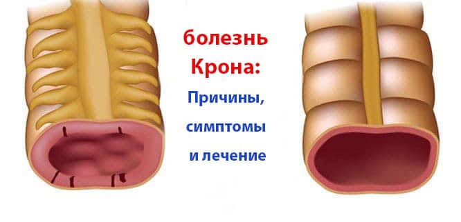 Подробнее о статье Что такое болезнь Крона? Причины, симптомы и лечение