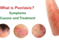 What is psoriasis? Symptoms, causes and treatment methods