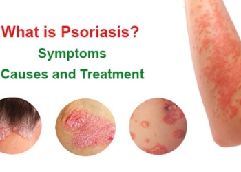 What is psoriasis? Symptoms, causes and treatment methods