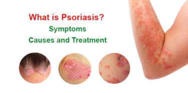 Read more about the article What is psoriasis? Symptoms, causes and treatment methods