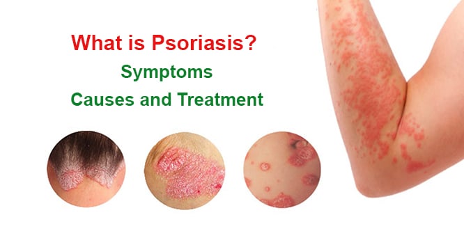 You are currently viewing What is psoriasis? Symptoms, causes and treatment methods