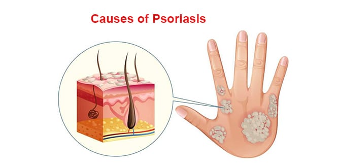 What Is Psoriasis Symptoms Causes And Treatment