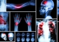 What causes bone cancer? Symptoms, stages and treatments
