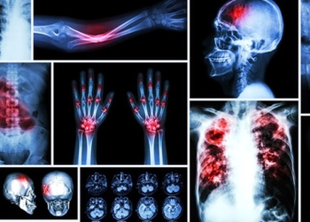 What causes bone cancer? Symptoms, stages and treatments