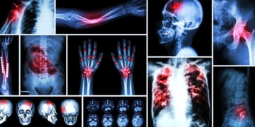 What causes bone cancer? Symptoms, stages and treatments