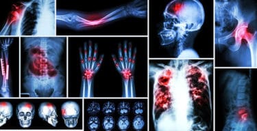 Read more about the article What causes bone cancer? Symptoms, stages and treatments