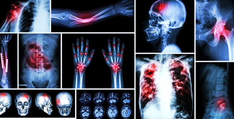 Read more about the article What causes bone cancer? Symptoms, stages and treatments