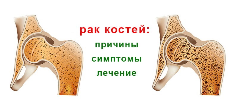 Симптомы рака костей. Онкология костей название. Онкология костей симптомы и лечение. Онкология съедение тела костей.