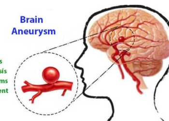 Was ist ein Aneurysma? Ursachen, Diagnose, Symptome und Behandlung