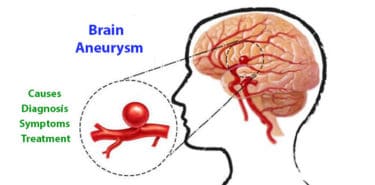 Read more about the article What is Aneurysm? Causes, Diagnosis, Symptoms and Treatment