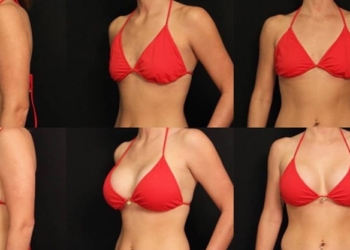 Breast augmentation guide: Best methods, surgery, recovery and cost