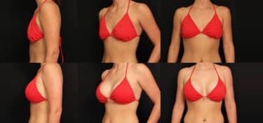 Read more about the article Pictures of the breast augmentation surgery: Before and After Photos