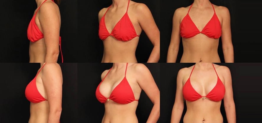 You are currently viewing Pictures of the breast augmentation surgery: Before and After Photos