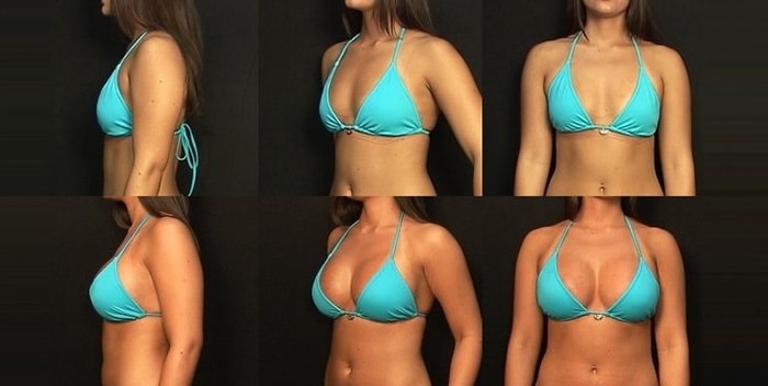Pictures of the breast augmentation, before and after surgery.