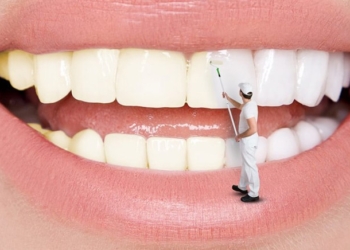 Porcelain veneers: Procedure, complications and cost of dental crowns