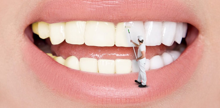 You are currently viewing Porcelain veneers: Procedure, complications and cost of dental crowns