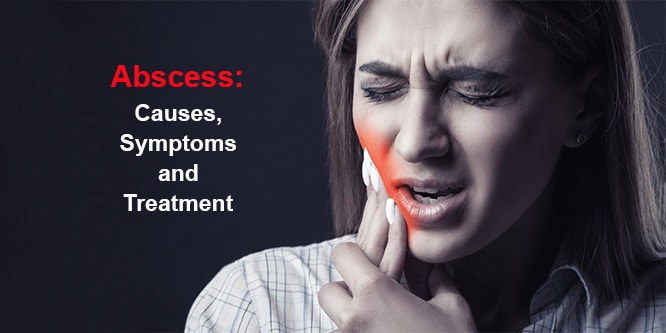 You are currently viewing Tooth abscess: Causes, symptoms, treatment and home remedies