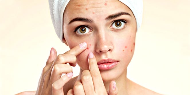 You are currently viewing How to stop inflamed acne? Causes, Symptoms and Treatment