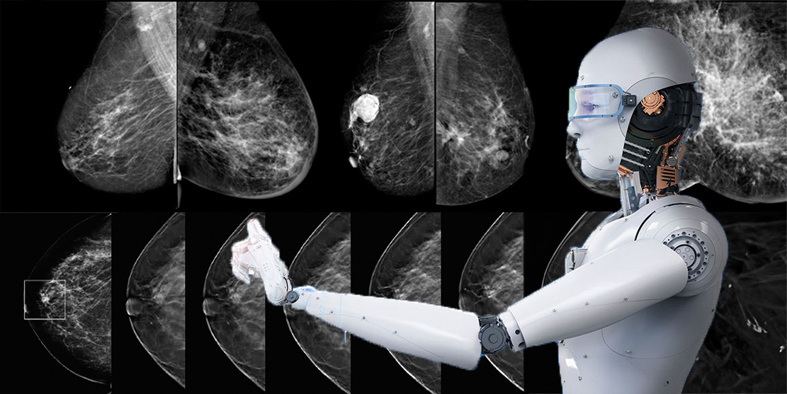 You are currently viewing AI Shows Equal Accuracy as Radiologists in Breast Cancer Screening