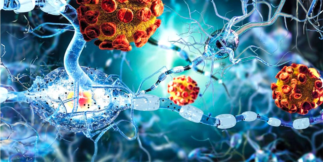 You are currently viewing Inverse Vaccine Could Treat Multiple Sclerosis and Many Autoimmune Diseases