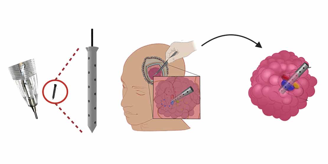 Read more about the article New Microdevice Offers Innovative Personalized Treatment for Brain Cancer