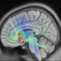 AI + Deep Brain Stimulation Could Unlock Paths to Depression Recovery