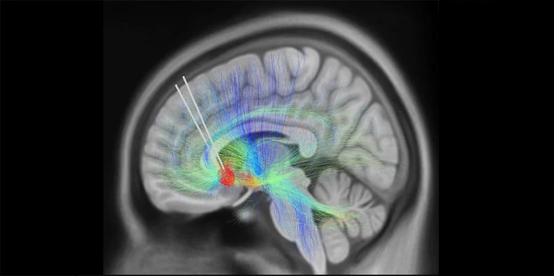 Read more about the article AI + Deep Brain Stimulation Could Unlock Paths to Depression Recovery
