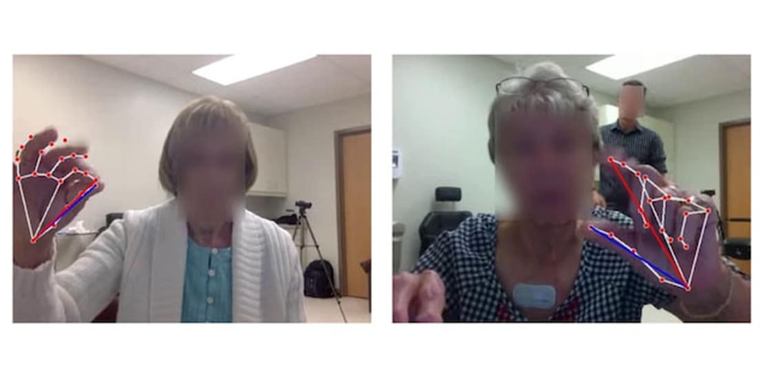 Read more about the article AI Tool Shows Promising Results in Assessing Parkinson’s Severity