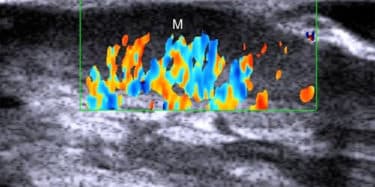 Read more about the article Non-Surgical Skin Cancer Treatment Achieves 99% Cure Rate