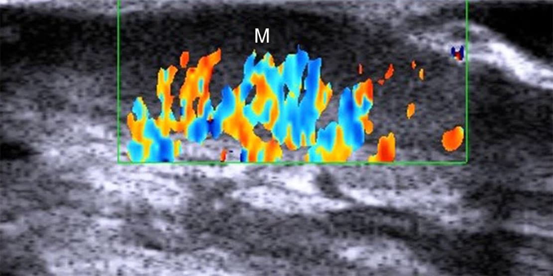 You are currently viewing Non-Surgical Skin Cancer Treatment Achieves 99% Cure Rate